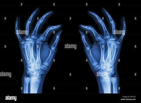 X Ray Normal Human Hands Front On Black Background Stock Photo Alamy