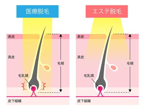 【医療脱毛とエステ脱毛の違い】を医師が比較して紹介！どっちが良い？ グランツクリニック