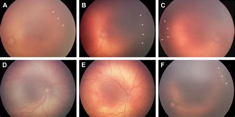 Telemedical Diagnosis Of Retinopathy Of Prematurity Ophthalmology