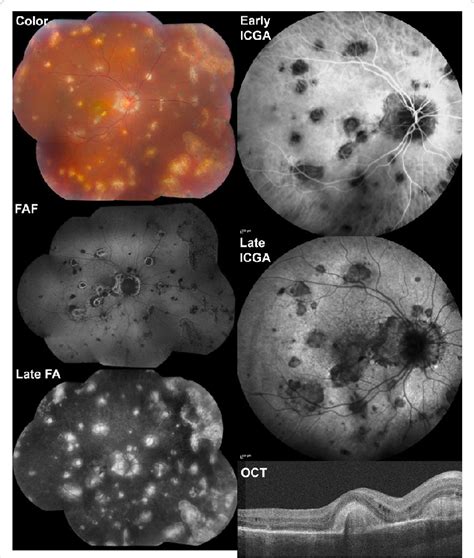 Multimodal Imaging Of A 29 Year Old Woman With Multifocal Choroiditis