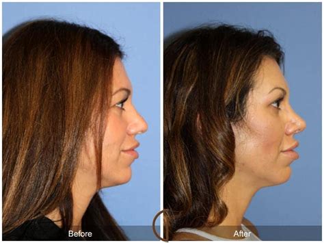 Tip Rhinoplasty Before After Photos From Dr Kevin Sadati