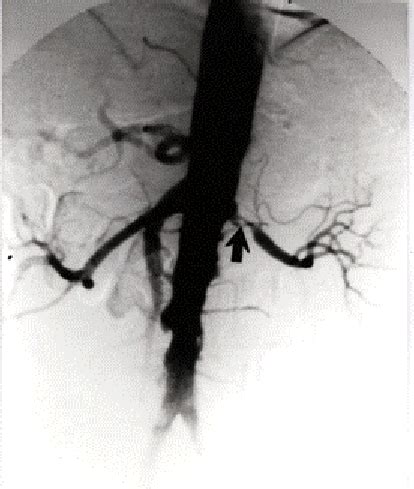 Postoperative Angiogram Showing Widely Patent End To End Splenic Artery