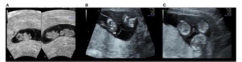 Figure 1 From Twin Twin Transfusion Syndrome After Radiofrequency