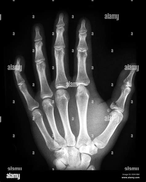 X Ray Showing An Avulsion Fracture Of The Proximal Phalanx Of The Thumb