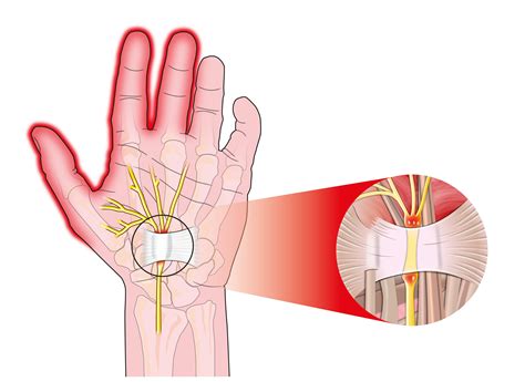 Ulnar Tunnel Syndrome Blog Axis Orthopedic Hospital Blog Axis Orthopedic Hospital