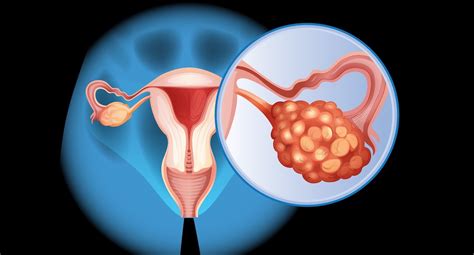 Ovarian Cancer Stages Symptoms And Treatment Options