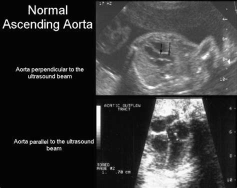 Normal Size Of Ascending Aorta