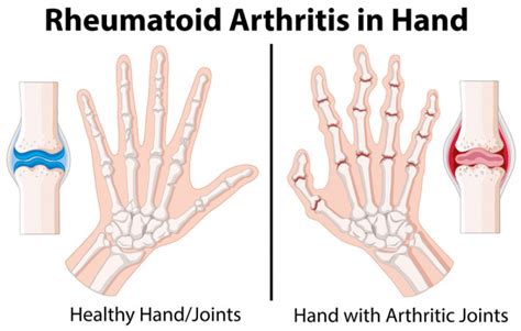 Common Hand Wrist Conditions Oxford Orthopaedics