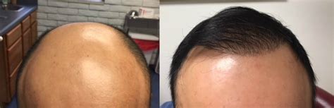 ARTAS Robotic Hair Transplant Benefits Cost Results More TBHR