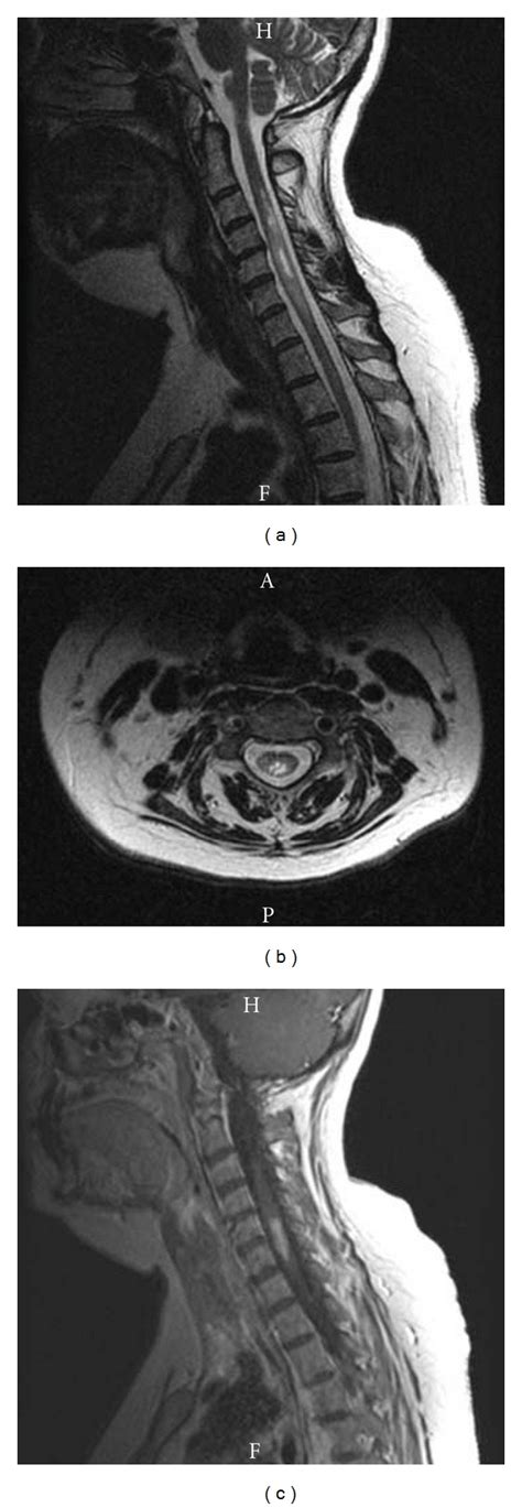 Cervical Spinal Cord Lesion Mri