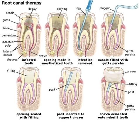 Understanding Root Canal Treatment for Front Teeth - Irvine Root Canal ...