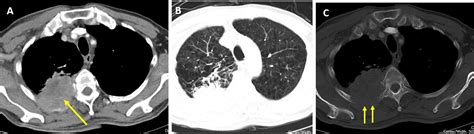 Lung Cancer Adenocarcinoma Radiology Cases