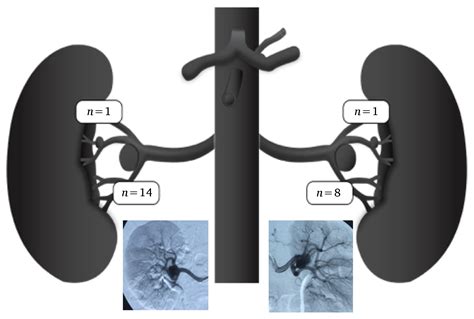 Direct Distal Renal Artery Aneurysm Repair European Journal Of