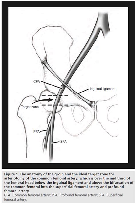 Femoral Artery Puncture