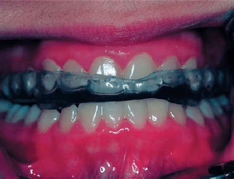 Michigan splint in the patient's mouth. | Download Scientific Diagram