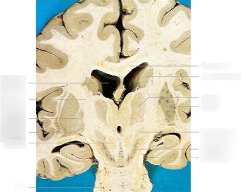 Coronal section of the basal ganglia Diagram | Quizlet