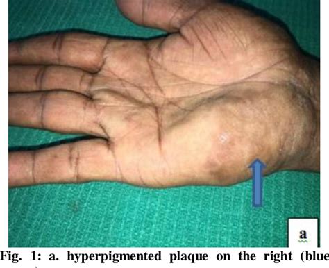 Figure From A Case Report Of Adult Onset Eccrine Angiomatous