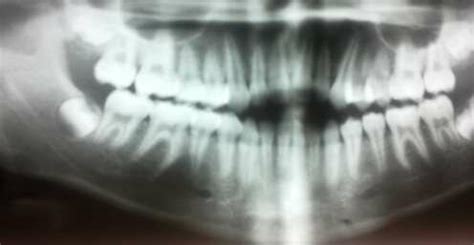 Panoramic Radiograph Showing A Well Defined Unilocular Radiolucency