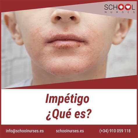 Imp Tigo Qu Es Enfermeras Escolares School Nurses