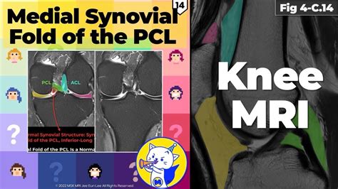 Fig 4 C 14 Medial Synovial Fold Of The Pcl Youtube