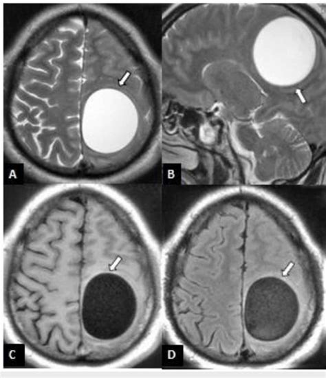 Mri Brain Of A 28 Year Old Patient With Cerebral Hydatid Cyst A Axial Download Scientific