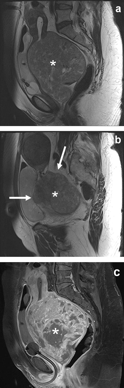 The Role Of Dynamic Contrast Enhanced And Diffusion Weighted Magnetic