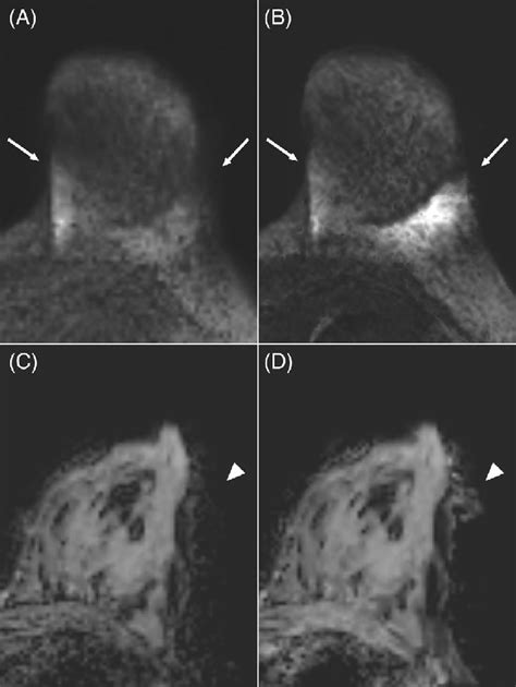 Characteristic Artifacts In Deep Learning Based K Space To Image And