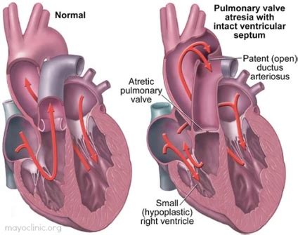 Heart Defects - Birth Defect Prevention