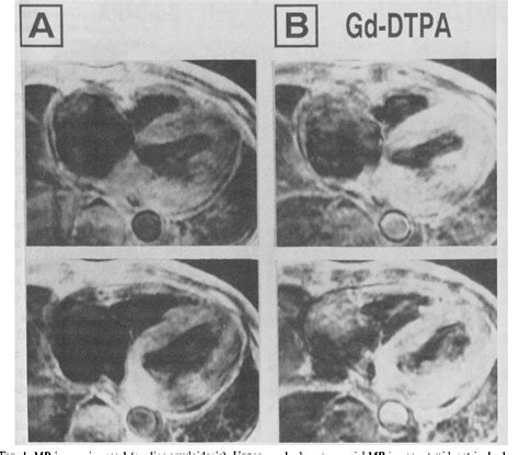 Figure 1 From Precise Assessment Of Myocardial Damage Associated With