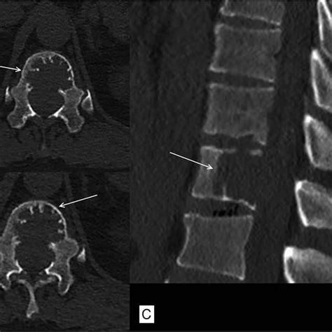 Axial A And B And Sagittal C Non Contrast Ct Images Showing Lytic Download Scientific