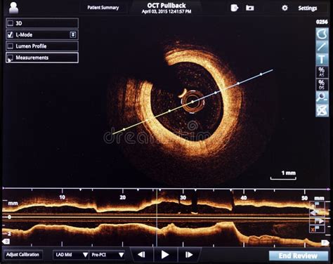 Optical Coherence Tomography Oct Image Angiography Catheter Lab