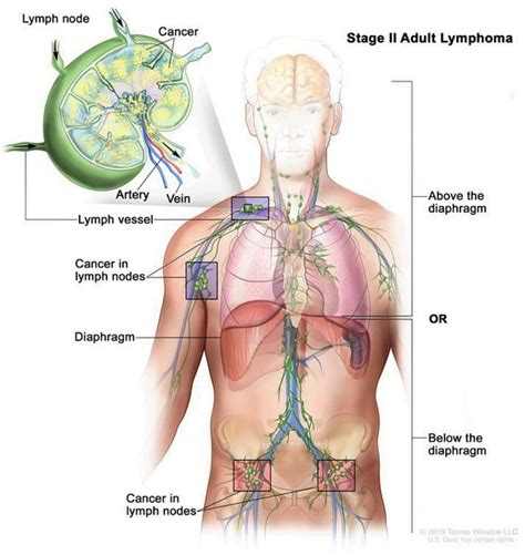 Ataxia-telangiectasia: MedlinePlus Genetics