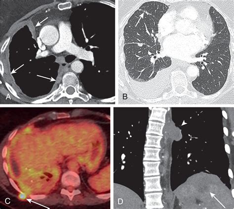 Pleural Tumors Clinical Tree