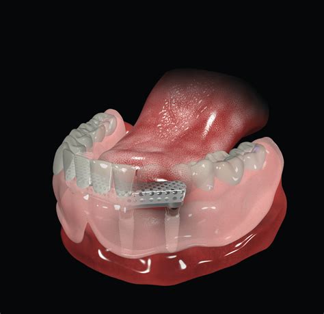 Bar-Retained Removable Overdentures (4 implants) | Megagen