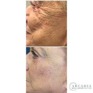 Before And After Long Lasting Bellafill Rejuvenation Arcadia