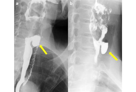 Comparison of esophagogram between Zenker diverticulum (arrow in a) and ...