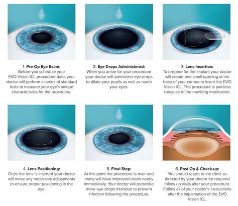 Implantable Collamer Lens Icl