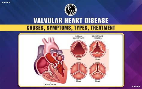 Valvular Heart Disease Causes Symptoms Types Treatment