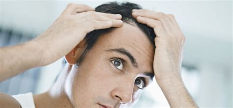 Receding Hairline Stages Causes And Treatments Mintop Hair