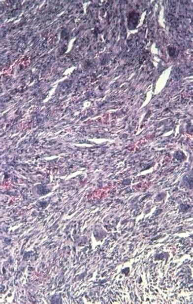 Malignant Fibrous Histiocytoma (Pleomorphic Sarcoma) - Pathology ...