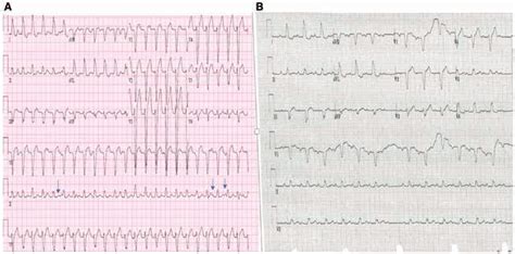 A Wide Complex Tachycardia With A Left Bundle Branch Block Morphology