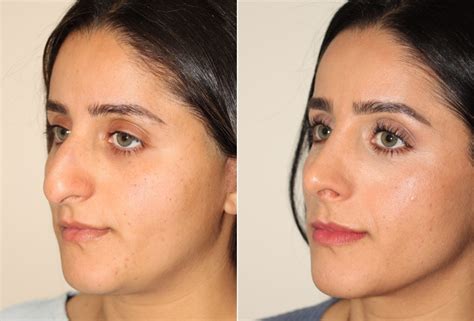 Rhinoplasty Dr Denton