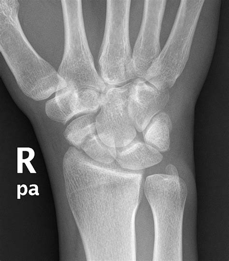 Scaphoid Bone Anatomy