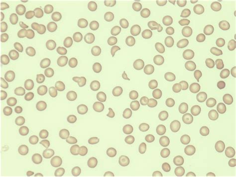 Peripheral blood smear showing schizocytes (magnification, 400 × ...