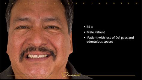 Aesthetic implant occlusion reconstruction - Case Study