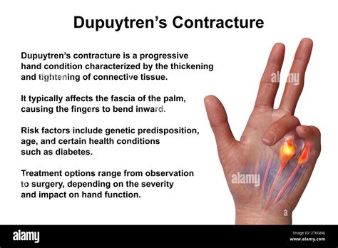 A D Medical Illustration Displaying A Patient S Hand With Dupuytren S