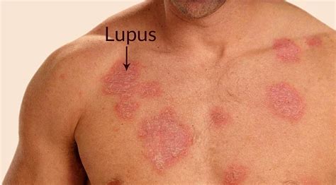 Sistemik Lupus Erİtematozus SLE Prof Dr Ediz Dalkılıç İç