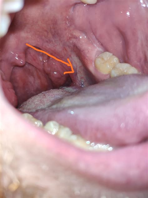 Part Of Throat Gone Pale Yellow On Both Sides Doctor Said I Have Ulcer From Molars Coming