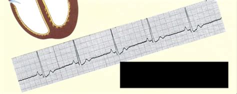 Exam 1 EKGs Flashcards Quizlet