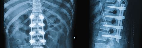 PSEUDARTHROSIS - Longhorn Brain and Spine